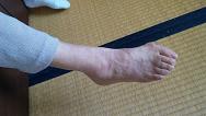 母、骨折した右足のギプスとれる!