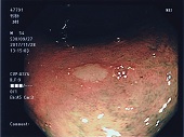 ポリープ発見！―大腸ガン内視鏡検査