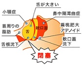 閉塞性睡眠時無呼吸症候群の原因―ＹＡＨＯＯ！画像